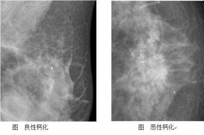 诊断篇005———什么是乳腺钙化