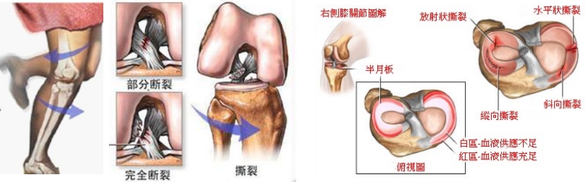 关于膝关节交叉韧带和半月板损伤的那些事