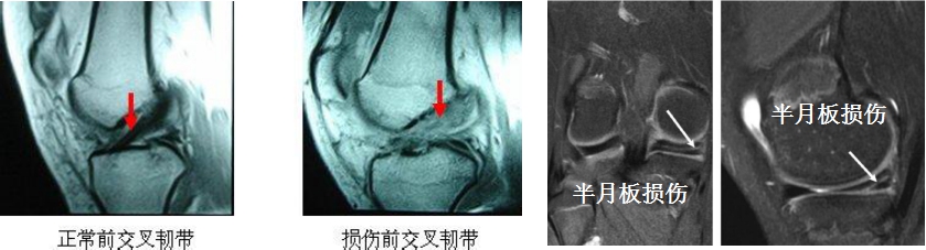 关于膝关节交叉韧带和半月板损伤的那些事