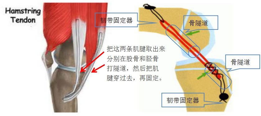 把它重新植入关节内,常用的是膝关节内侧的半腱肌腱和股薄肌腱,具有