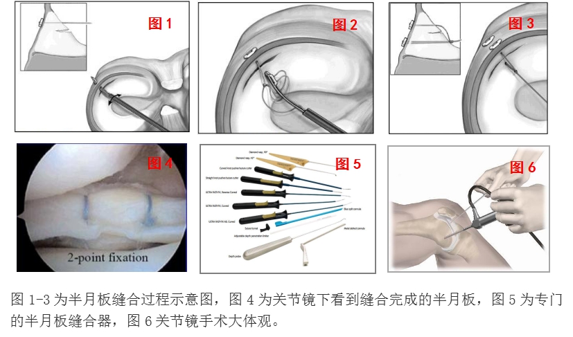 头通过约8mm的皮肤切口伸进关节腔内,然后使用专门设计的半月板缝合
