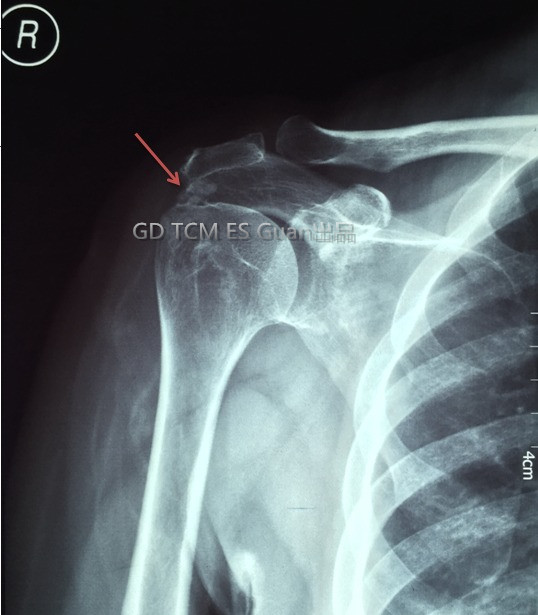 x线片显示:右肩关节退变,肱骨大结节上方钙化灶形成