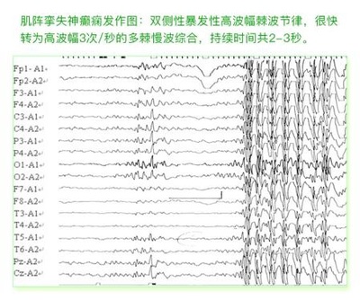 癫痫病各种脑电图波形解答