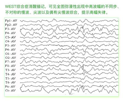 但是没有医学常识的患者是看不懂脑电图检查结果的,他们又非常想知道