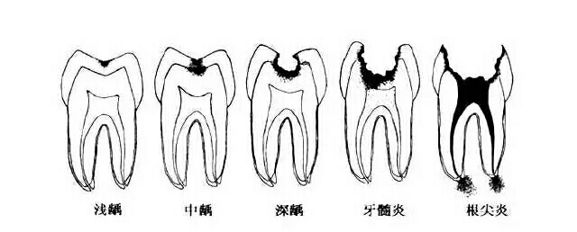 (龋齿的发展过程)