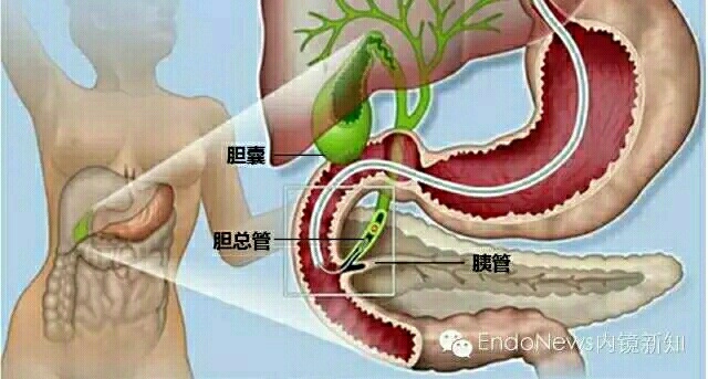 ercp,你听说过吗?