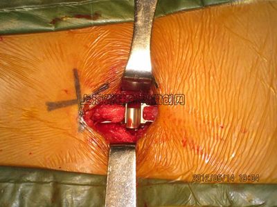 腰椎管狭窄哪里治疗好?