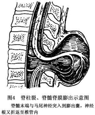 脊柱裂-脊膜膨出-脊髓拴系