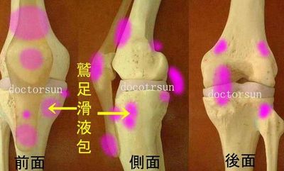 鹅足腱滑囊炎