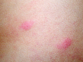 荨麻疹是一种极其常见的过敏性皮肤病,俗称"风疹块.