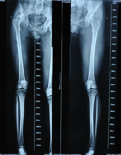 32岁男性患者股骨头缺血坏死v期,髋关节半脱位,下肢短