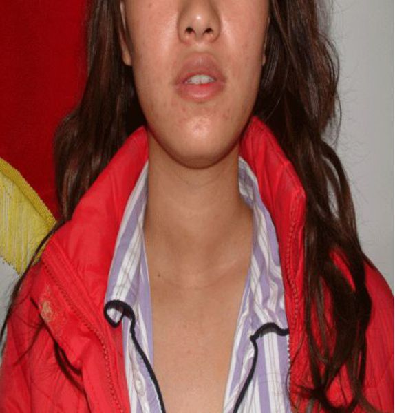 广东 东莞 东莞市东华医院 李君久 医生文章 文章详情