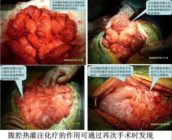 粘液瘤減瘤術與其併發症 | 微醫