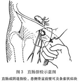 女性闭孔疝位置图片