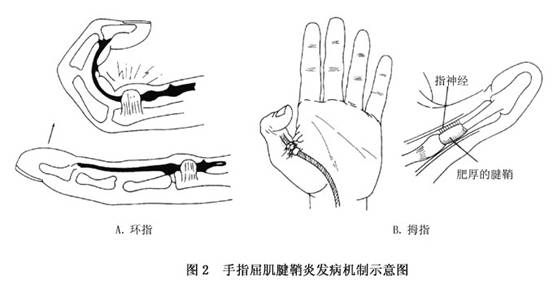 屈指肌腱腱鞘炎图片