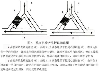 ②折返 折返是室上性快速心律失常发生的常见机制