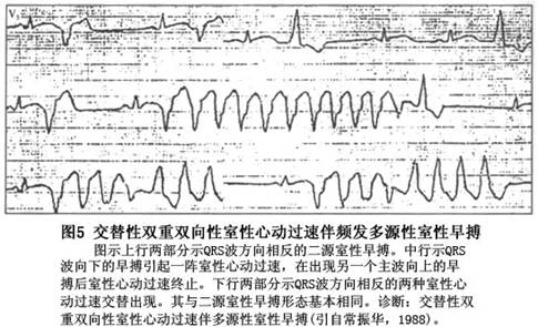 (8)基礎心律可呈現多種心律:例如竇性心律,陣發性房性心動過速