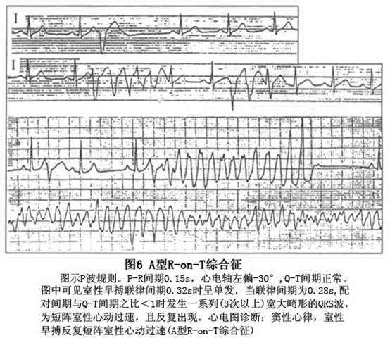 上,出現較早的室性期前收縮r-on-t,可引起短暫的陣發性室性心動過速