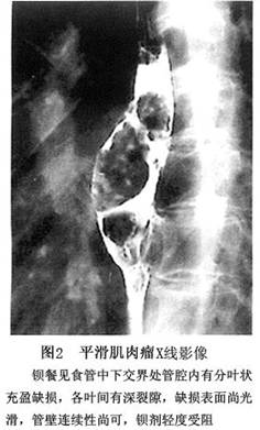 食管平滑肌瘤x线图片