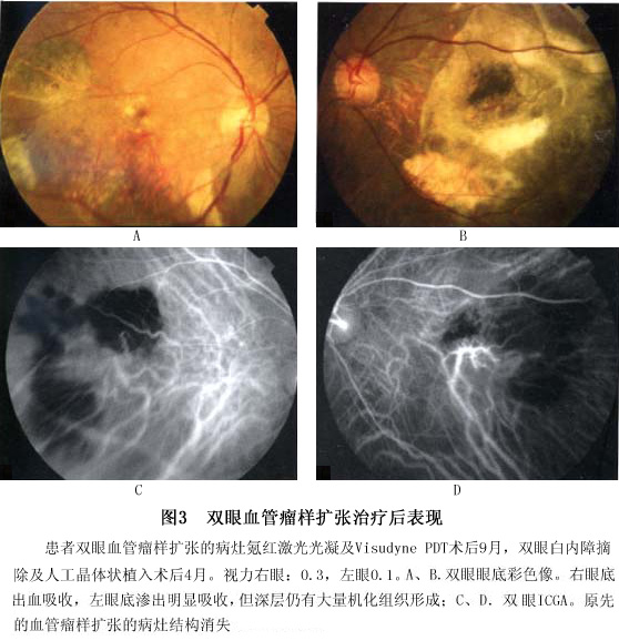 特发性息肉样脉络膜血管病变