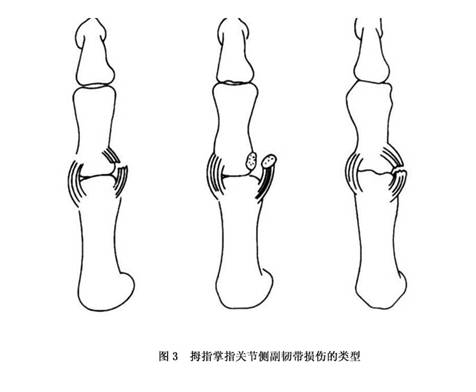 拇指掌指关节尺侧侧副韧带损伤