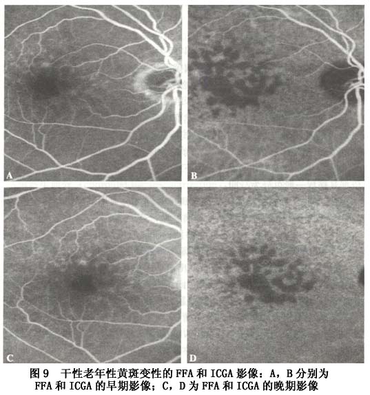 乾性amd吲哚青綠脈絡膜血管造影中玻璃膜疣從始至終均表現為遮蔽
