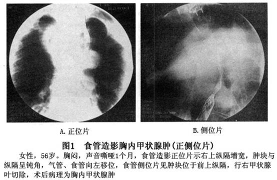 縱隔密度稍增高,常可壓迫氣管,可借氣管的弧形壓跡而推測有腫瘤的存在