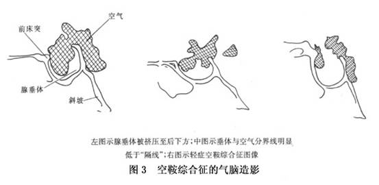 空蝶鞍综合征眼部表现的临床分析