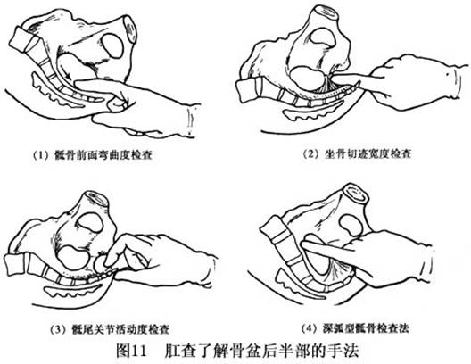 坐骨切迹宽度怎么测量图片