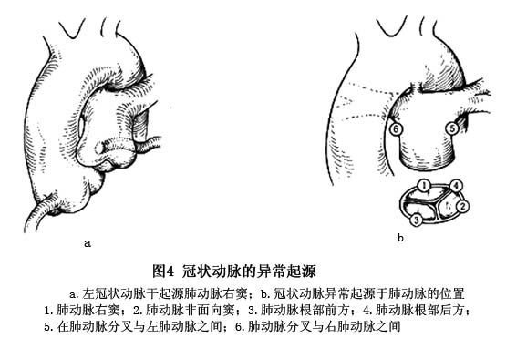 冠状动脉异常起源于肺动脉