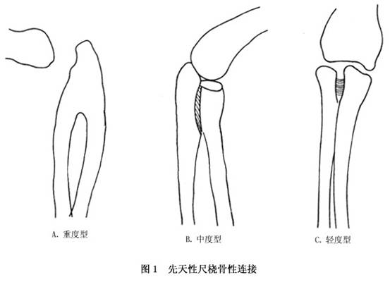 先天性尺桡骨融合图片图片