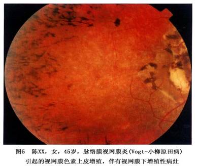 后葡萄膜炎