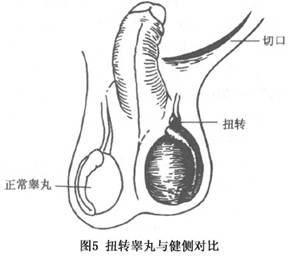 睾丸扭转症状图图片