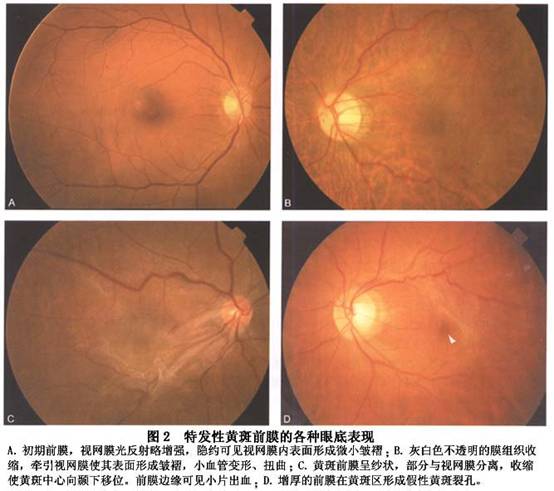 眼睛黄斑前膜图片图片
