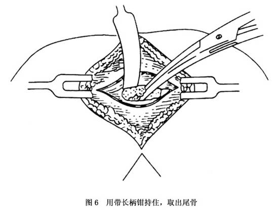 尾骨骨折保险多赔多少 尾骨骨折保险公司赔偿标准