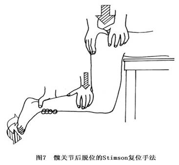 ④术后处理:单纯髋关节后脱位的患者手法复位后,可用皮肤牵引固定