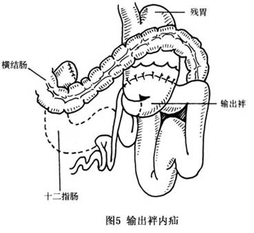 肠袢是什么意思 www.guahao.com