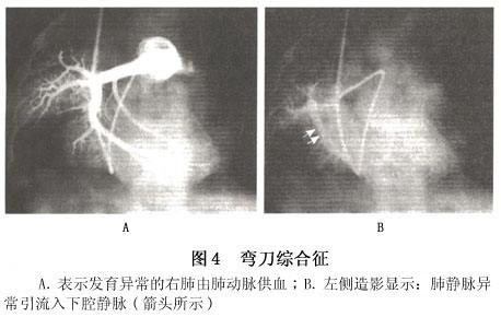 小兒部分性肺靜脈異位連接