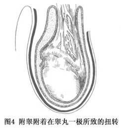 睾丸扭转图片识别图片