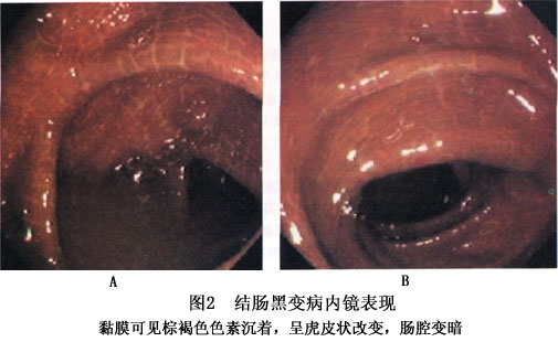 结肠黑变病