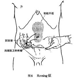 rovsing征图片