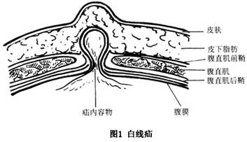 白线疝