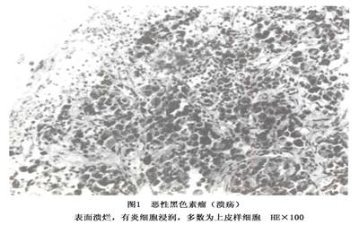 什么是黑色素细胞痣 7b229e4cbfcdf78304e321417a3e3d56.jpg