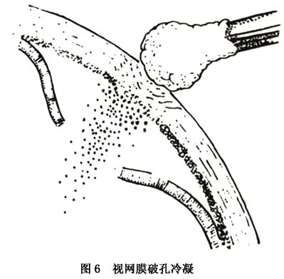 增生性玻璃體視網膜病變