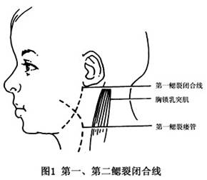 鳃裂囊肿和瘘详情