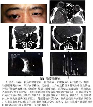 脑膜膨出图片