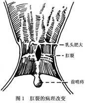 肛裂三期图片图片