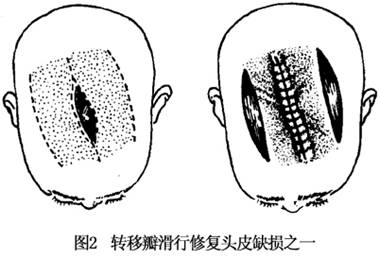 (2)头皮复杂裂伤:处理的原则亦应及早施行清创缝合,并常规用