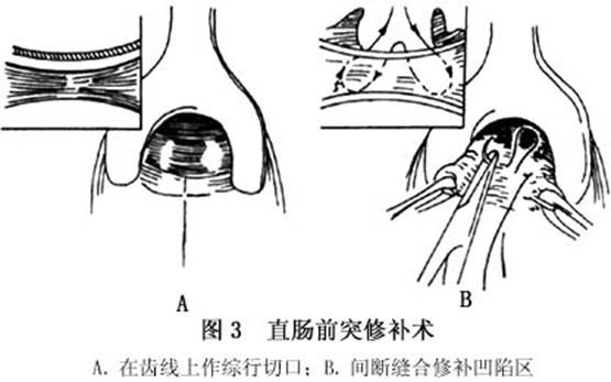 直肠膨出图片图片