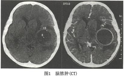 腦膿腫